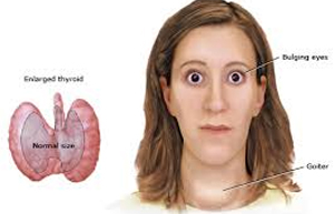 Hyperthyroidism