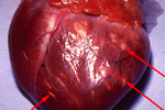 myocarditis