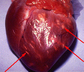 myocarditis